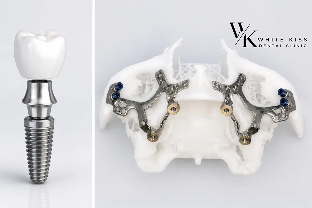Comparație între Implanturile Tradiționale și Cele Personalizate de la WhiteKiss