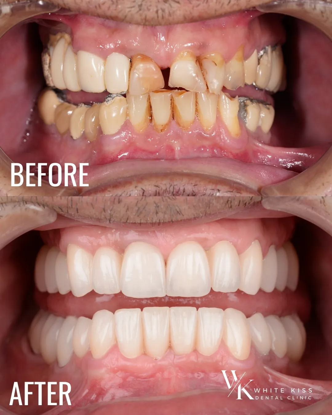 Reabilitare Orală Completă cu Implanturi și Coroane Premium din Ceramică pe Zirconiu – O Nouă Viață Începe cu un Zâmbet WhiteKiss