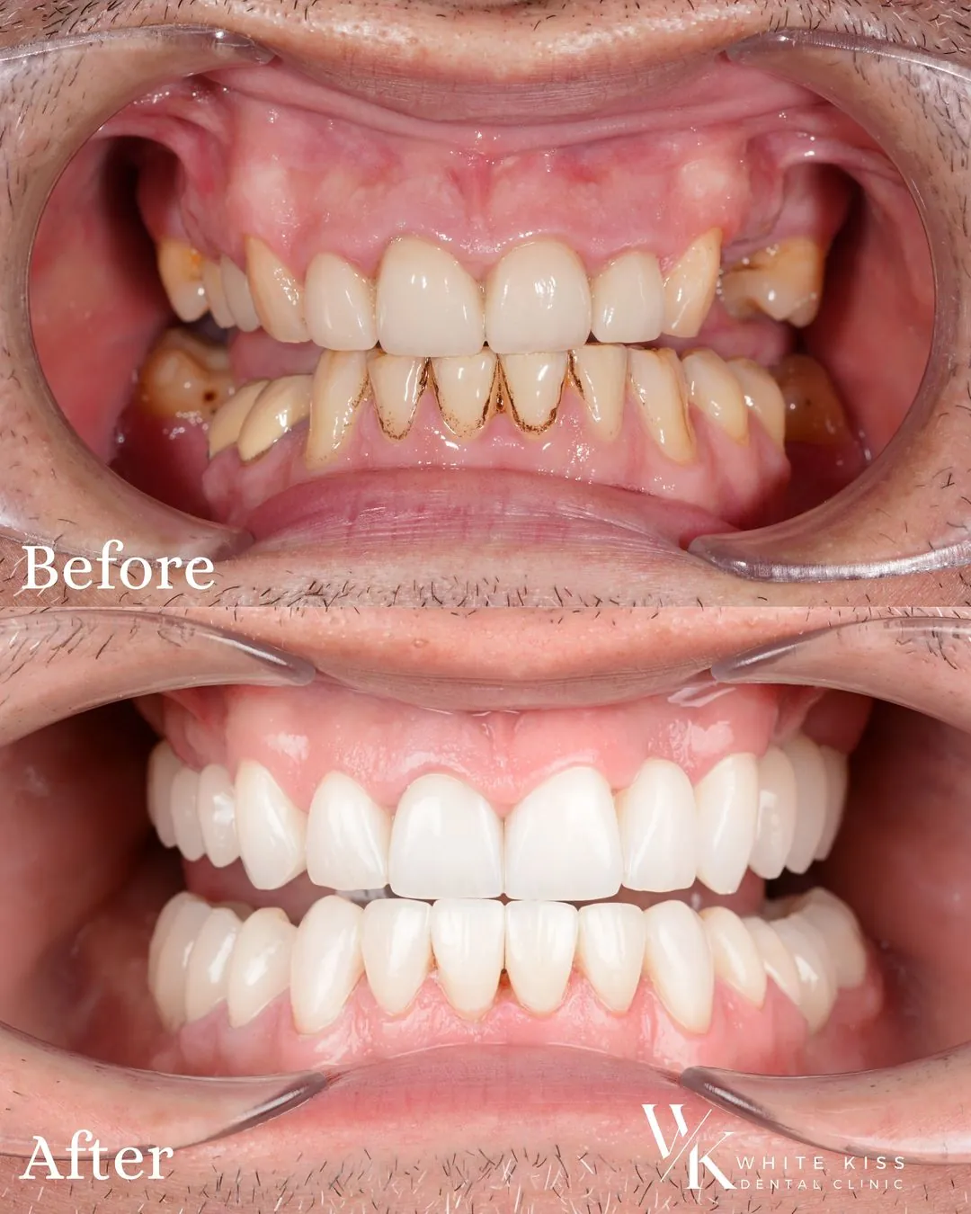 De la Diagnostic la Zâmbet Complet: Reabilitare Orală cu Implanturi Dentare și Protetică Avansată